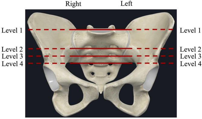 How precise is excision and reconstruction using 3D printing technology for total sacrectomy: accuracy validation in 9 consecutive cases.