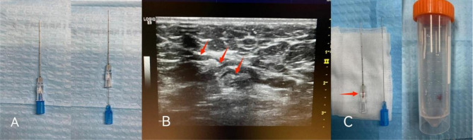 Intraoperative ultrasound-guided wire(IOUS-wire) localization biopsy versus preoperative fine needle aspiration cytology(FNAC) for early breast cancer with clinically positive nodes, a retrospective cohort study.