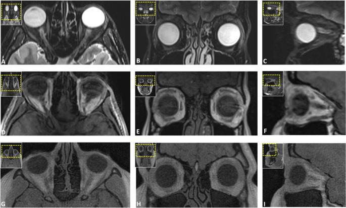 Black bone and CT-like MRI-based delineation of fracture-prone regions in oral and maxillofacial trauma.