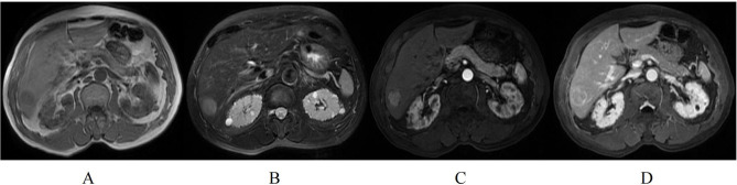 Prognostic Value of Gd-BOPTA Enhanced MRI in Solitary Resected Hepatocellular Carcinoma Without Microvascular Invasion.