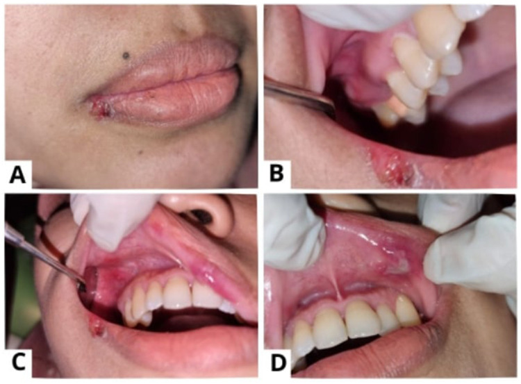 Identifying the Multifactorial Triggers of Monthly Recurrent HSV-1 Reactivation: A Case Report.