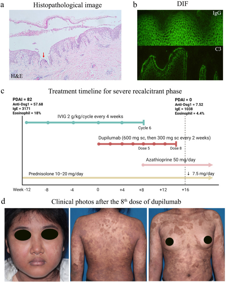 Dupilumab as Immunomodulatory Rescue for Severe Recalcitrant Pemphigus Vulgaris: A Case Report and Literature Review.