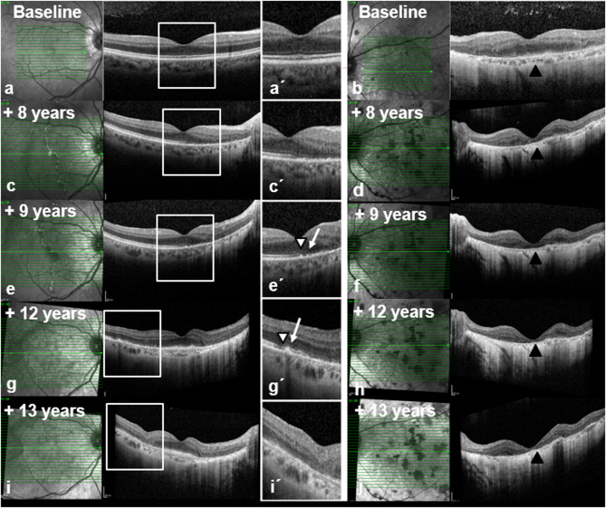 Multizonal outer retinopathy and retinal pigment epitheliopathy (MORR) with a chronologically divergent presentation- a case report.