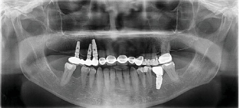 Implant Osseointegration Adjacent to a Retained Root Fragment: A Case With 11-Year Follow-up.