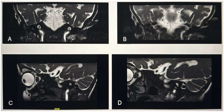 Cochlear implantation in children with Bartter syndrome: A case report.