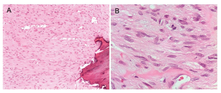 Myofibromas of the jawbones in pediatric patients. A clinicopathological study.