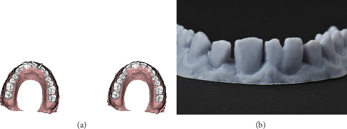 Esthetic Management in Geminated and Supernumerary Maxillary Incisor Teeth With a Conservative Interdisciplinary Approach.