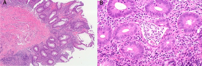 A Case Report on the Development of Ulcerative Colitis During Osimertinib Therapy for Epidermal Growth Factor Receptor Mutation-Positive Non-Small-Cell Lung Cancer.