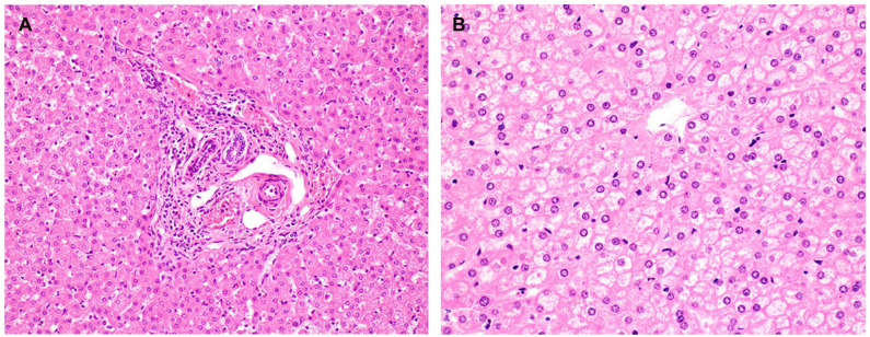 Nodular Regenerative Hyperplasia Is a Frequent Finding in Explanted Livers of Patients With Maple Syrup Urine Disease.