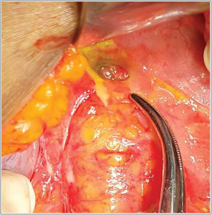 Perforated Peptic Ulcer in Lagos. Risk Factors and Management Outcome.