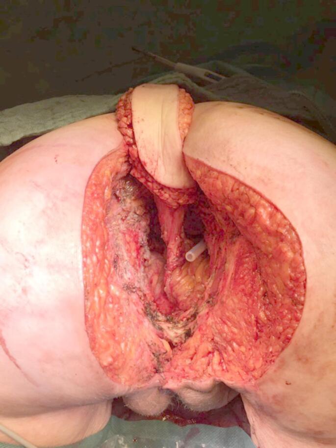Reconstruction of the perineal defect after abdominoperineal resection with vertical rectus abdominis myocutaneous (VRAM) flap versus primary direct closure - a single center retrospective cohort study.