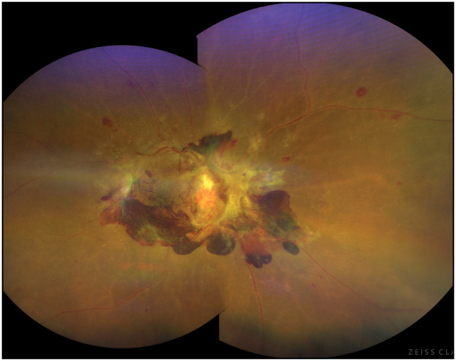 Proliferative Diabetic Retinopathy in Nigerians: Treatment Methods, Visual Outcomes, and Predictors of Poor Outcomes.
