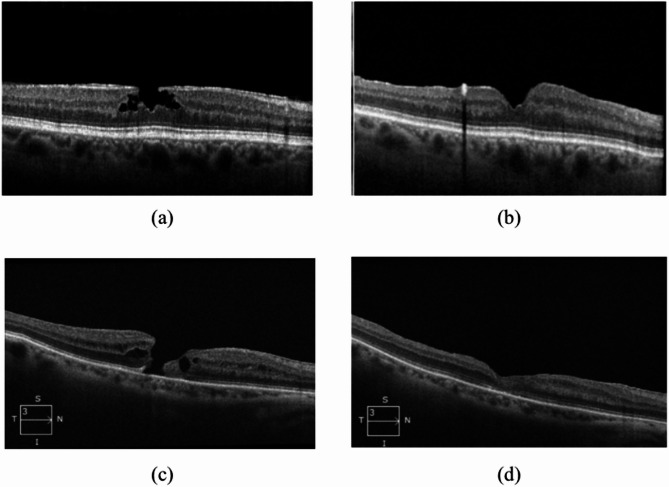 Long-term optical coherence tomography changes and visual outcomes after vitrectomy for epiretinal proliferation: lamellar holes and full-thickness macular holes.
