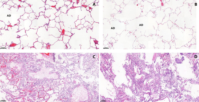 Ageing and dysregulated lung immune responses in fatal COVID-19.