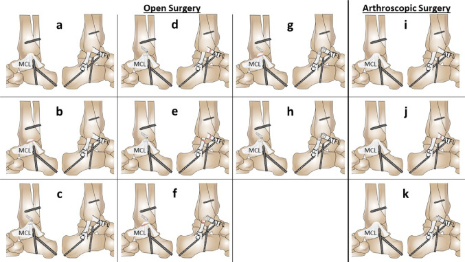 Biomechanical testing of lateral and medial ligament reconstruction using bone anchors with autologous resident tissue: influence of different reconstruction techniques on stability and mobility.