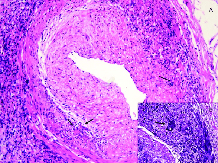 Diagnostic Dilemmas in Giant Cell Arteritis: Overcoming Anchoring Bias.