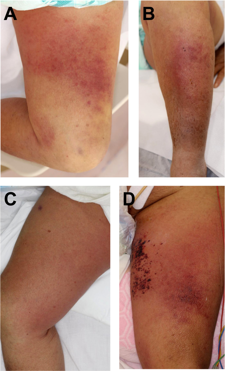 <i>Listeria monocytogenes</i> bacteremia accompanied by skin lesions on the legs.