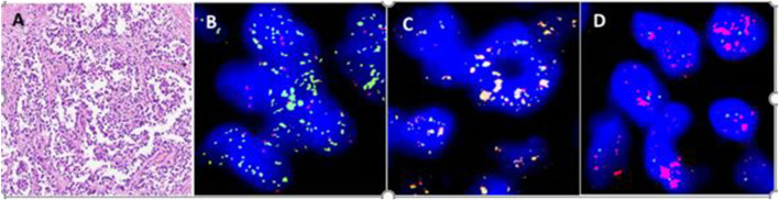 The implications of abnormal signal patterns of break-apart FISH probes used in the diagnosis of bone and soft tissue tumours.