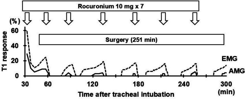 A patient with myasthenia gravis showing lower sensitivity to rocuronium and earlier recovery of train-of-four responses on electromyography compared to acceleromyography: a case report.