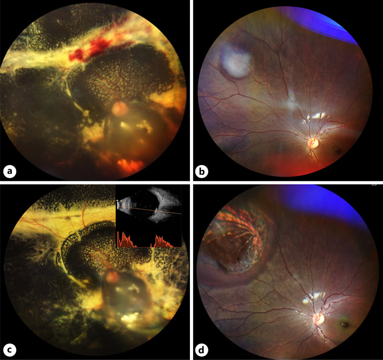 Late-Onset Bilateral Retinoblastoma in Adolescence with Successful Globe Salvage.