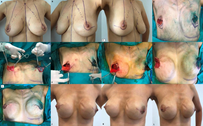 Simultaneous Implant and Dermal Flap Technique for Breast Reconstruction After Skin-Sparing Total Mastectomy for Breast Carcinoma.