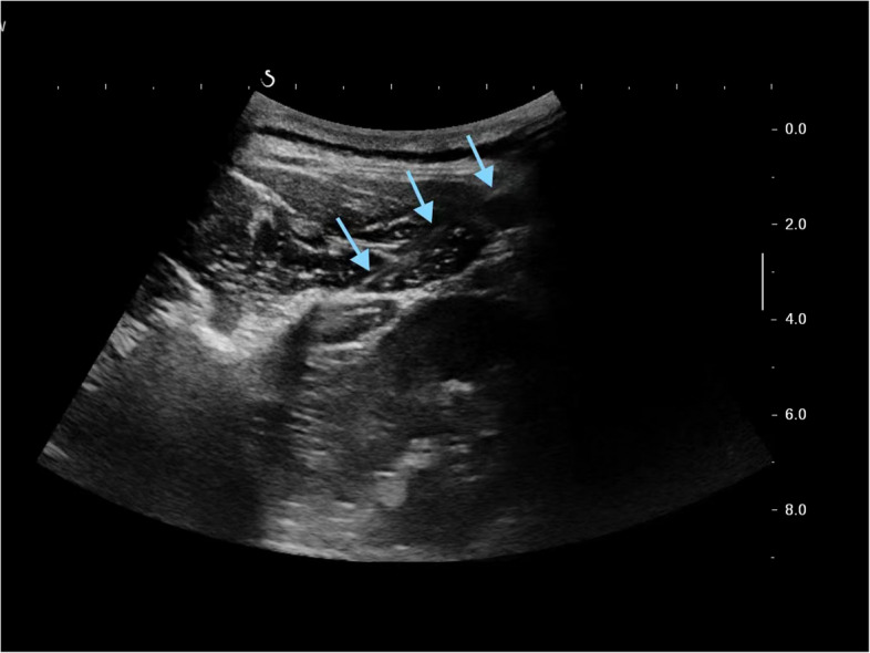 Precision targeting in acupuncture: a pilot and feasibility study protocol of ultrasound-guided approach for non-specific low back pain.