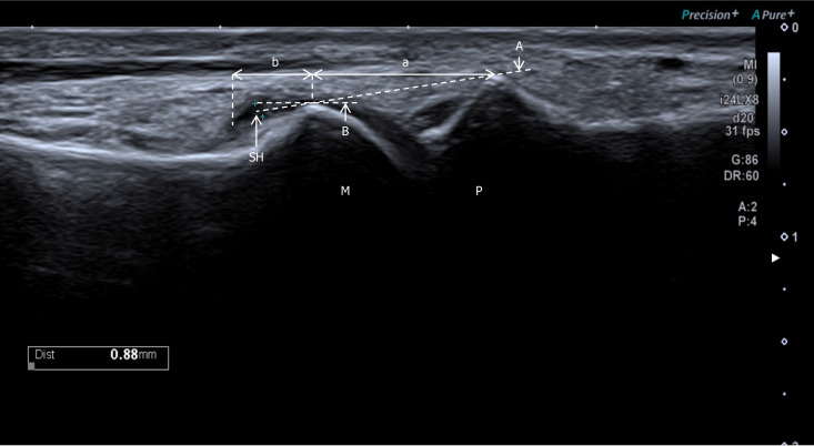 First metatarsophalangeal joint synovial hypertrophy associated with vitamin D status in type 2 diabetes mellitus: An ultrasound-graded study.