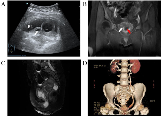 Incarcerated prolapsed ureterocele complicated by postoperative acute pyelonephritis: a case report.