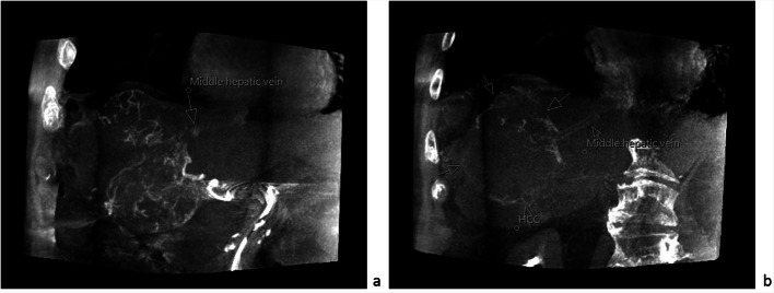 Assessment and clinical relevance of pulmonary shunt on <sup>166</sup>Ho-Scout Imaging in hepatocellular carcinoma.