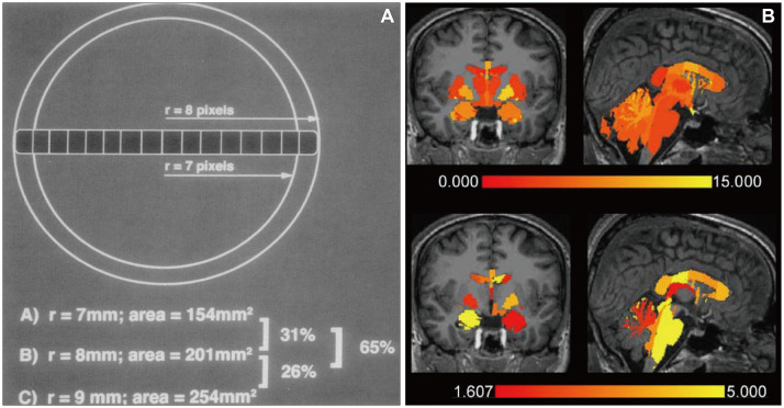 Current Clinical Applications of Structural MRI in Neurological Disorders.