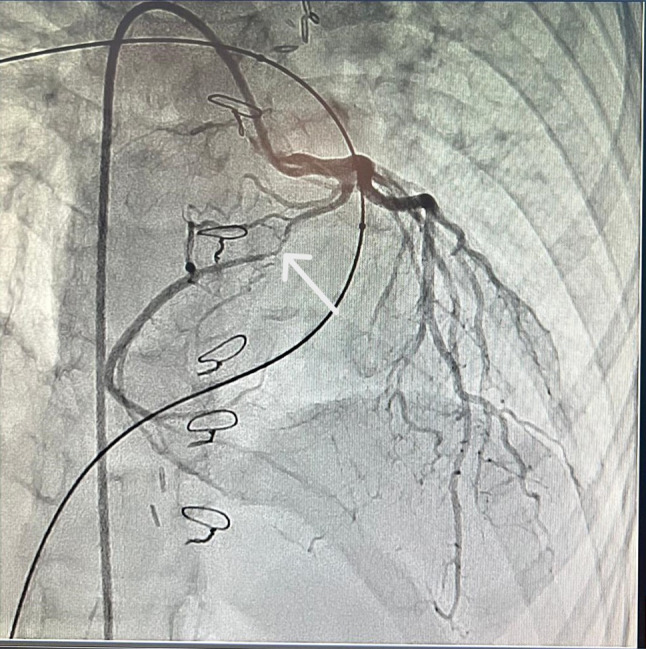 A rare case of coronary artery bypass grafting in pediatric cardiac surgery: emphasizing the importance of internal thoracic artery usage.