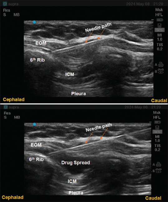 External oblique intercostal plane block in paediatric patients with thrombocytopenia for open splenectomy: Simple and promising….