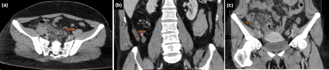 Evaluation of computed tomography (CT) appendicitis score and laboratory parameters in acute appendicitis with and without CT-detected appendicolith.