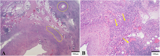 Fibrosing Mediastinitis in a 5-Year-Old Labrador Retriever.