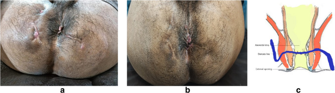 IFTAK (Interception of Fistulous Tract with Application of Ksharasutra) technique: a minimally invasive solution for recurrent fistula-in-ano-a case series analysis.