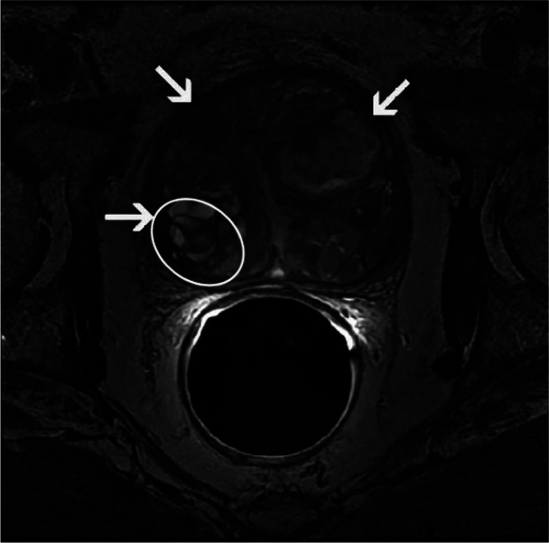 Emphasis on the management of embedded capsular hyperplasia nodules associated with benign prostatic hyperplasia.