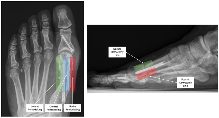 Preliminary Radiographic Classification of First Metatarsal Osteotomy Healing Following Minimally Invasive Hallux Valgus Surgery.