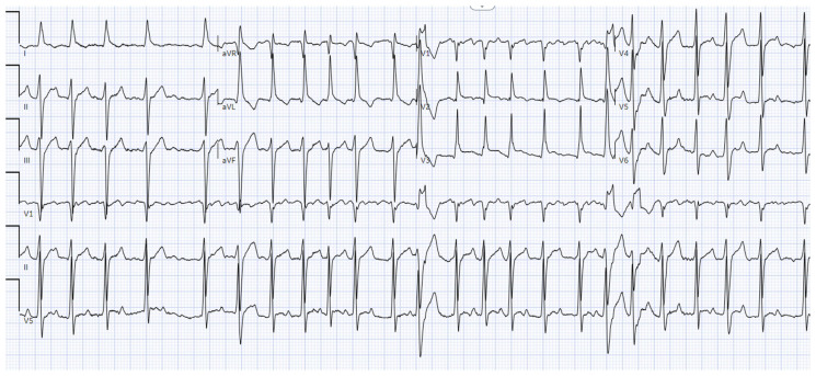 Beyond Atrial Fibrillation and Heart Failure: Ibrutinib-induced Pericardial Effusion.