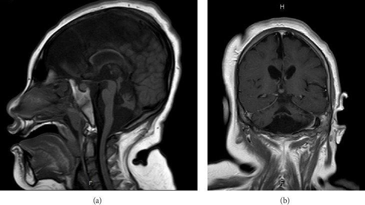 Pontocerebellar Hypoplasia Type 3 With Two Novel <i>PCLO</i> Gene Mutations: A Case Report.
