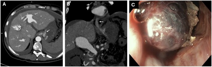 Hepatic barrage to high-flow, intra-hepatic arteroportal fistulas requiring combined interventional approach.