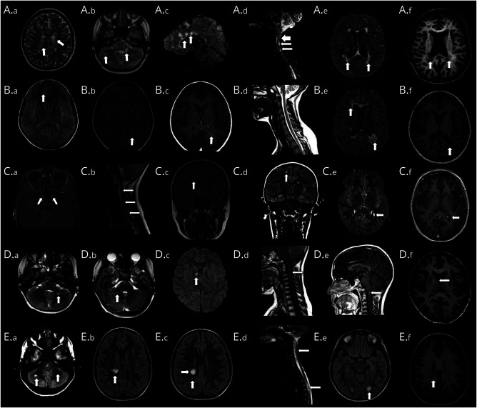 Clinical Features of Children With MOG-IgG Who Fulfill Criteria of Multiple Sclerosis and Overlapping Disorders.