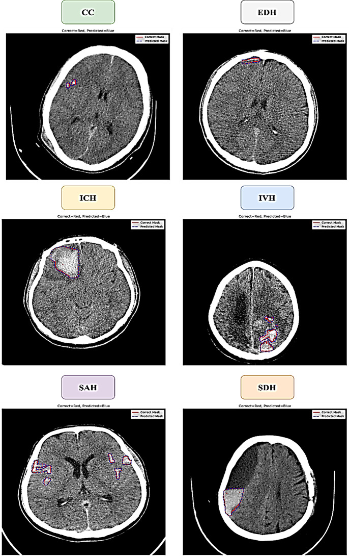 Advanced multi-label brain hemorrhage segmentation using an attention-based residual U-Net model.