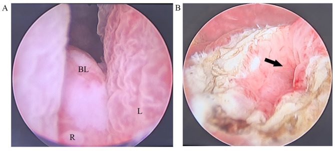 Incarcerated prolapsed ureterocele complicated by postoperative acute pyelonephritis: a case report.