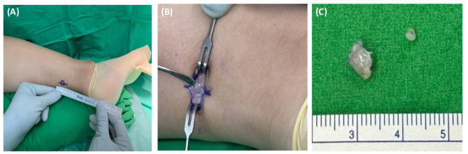 Painful Angiomyoma of the Heel Region: A Rare Case Report.