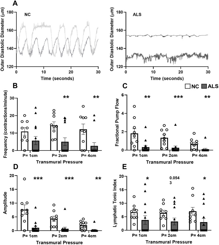 Lymphatic dysfunction correlates with inflammation in a mouse model of amyotrophic lateral sclerosis.
