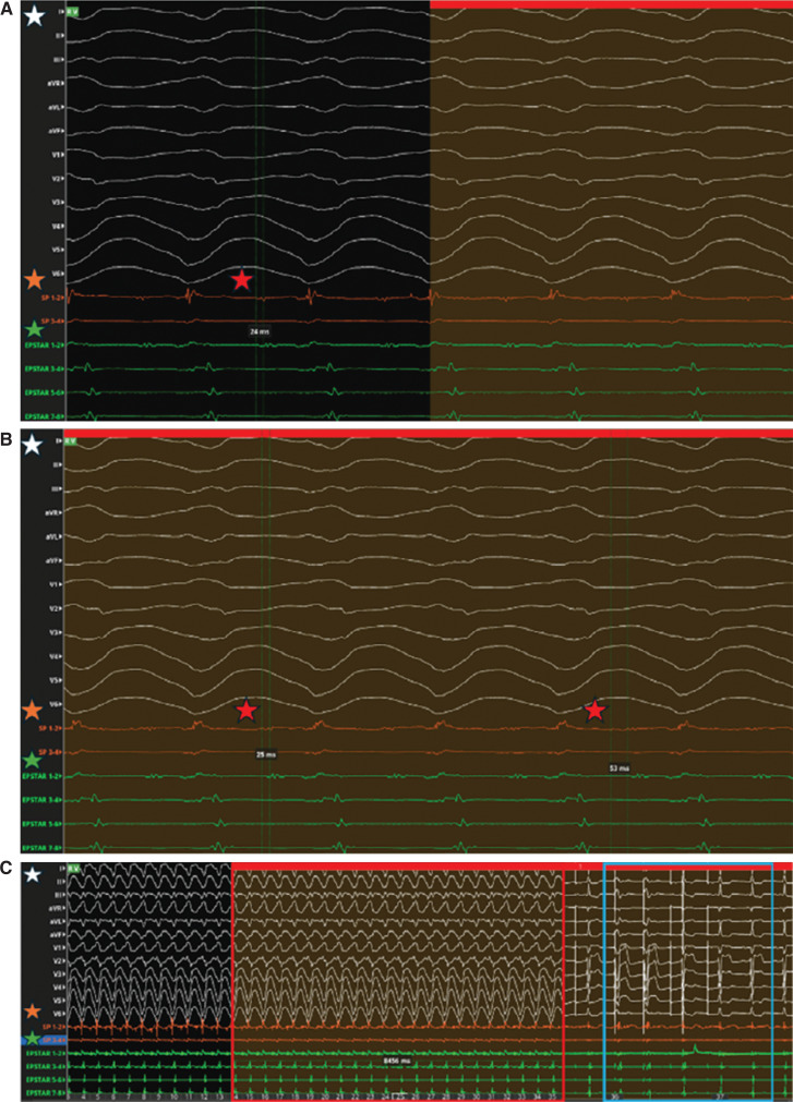 Electrogram Dynamics at the Site of Ventricular Tachycardia Termination During Radiofrequency Ablation.