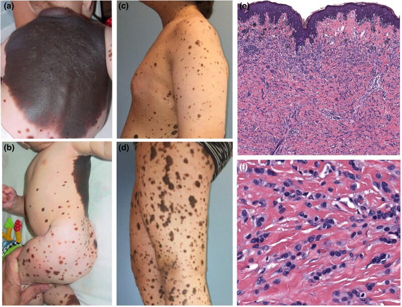 Congenital melanocytic naevi initiated by BRAF fusion oncogene with firmness, pruritus and desmoplastic stroma.