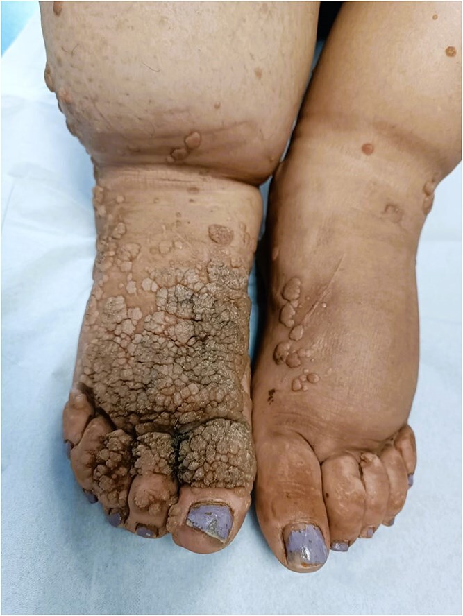 A case of classic epidermodysplasia verruciformis associated with elephantiasis: an atypical presentation.
