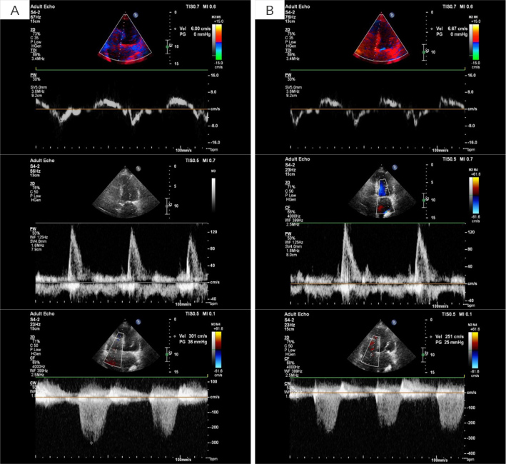A Novel, Non-Invasive AI-Based Telemonitoring System for Heart Failure: Detection of Undiagnosed Hyperthyroidism in an Asymptomatic Patient.