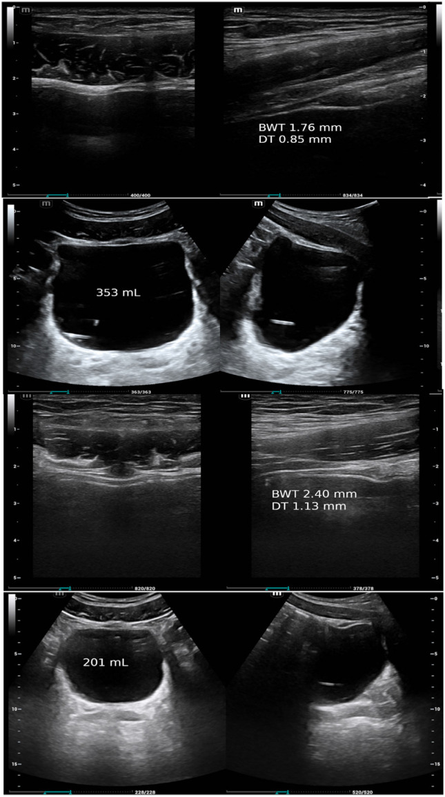 Ultrasonically Estimated Bladder and Detrusor Weights in Patients with Post-Void Residual Urine.